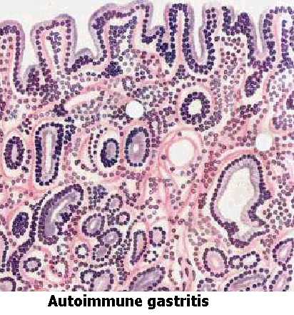 Autoimmune Gastritis